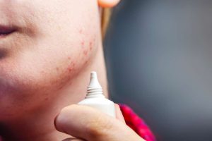 close-up-of-woman-applying-acne-cream-to-cheek-with-visible-red-spots-demonstrating-targeted-treatment